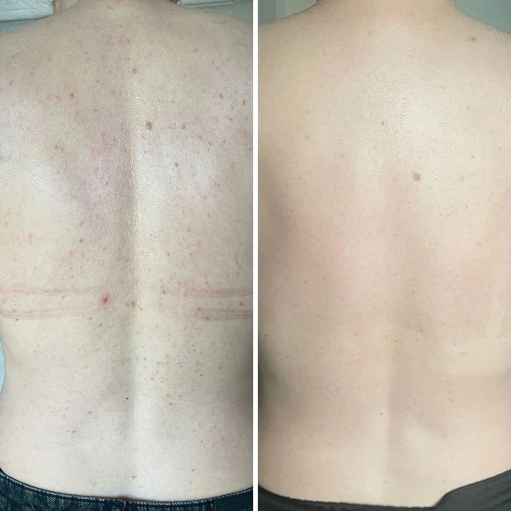 Salicylzuur spray tegen puistjes en verstopte poriën • 100ml